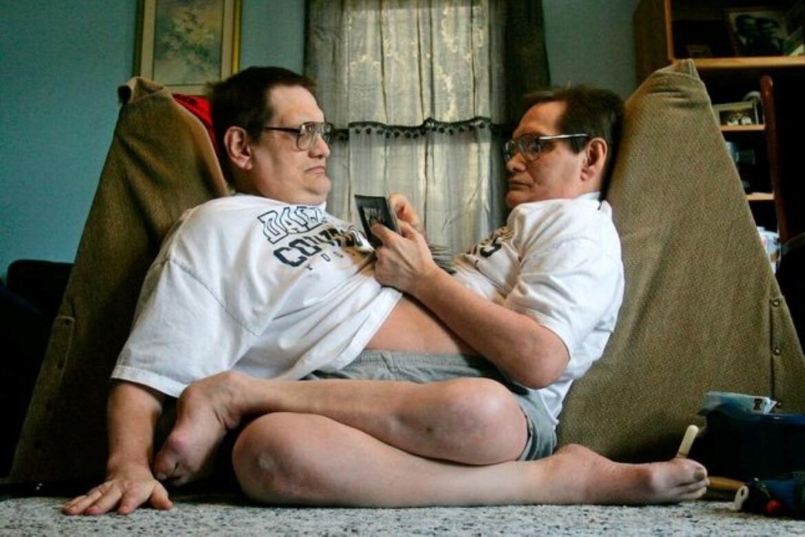 World’s Oldest Conjoined Twins Die At 68