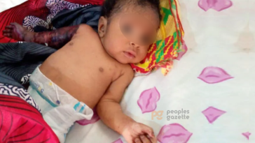 Two-month-old Miracle Chikwe with his broken right arm / Photo credit: Peoples Gazette