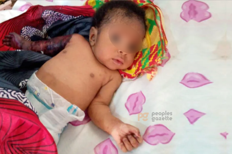 Two-month-old Miracle Chikwe with his broken right arm / Photo credit: Peoples Gazette
